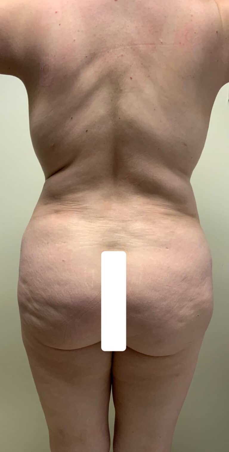 Before Image: Circumferential Mamacita Makeover - back