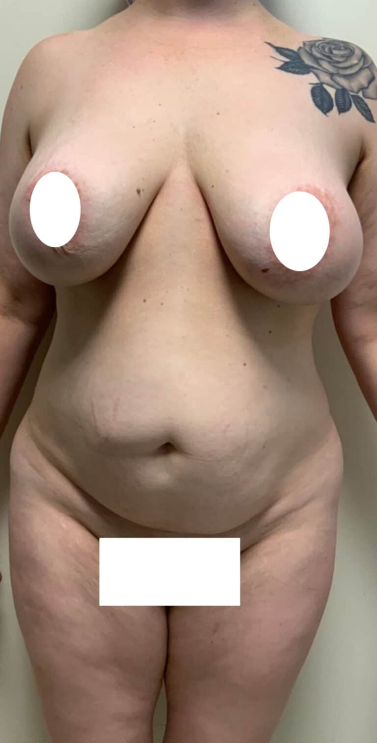 Before Image: Circumferential Mamacita Makeover - front