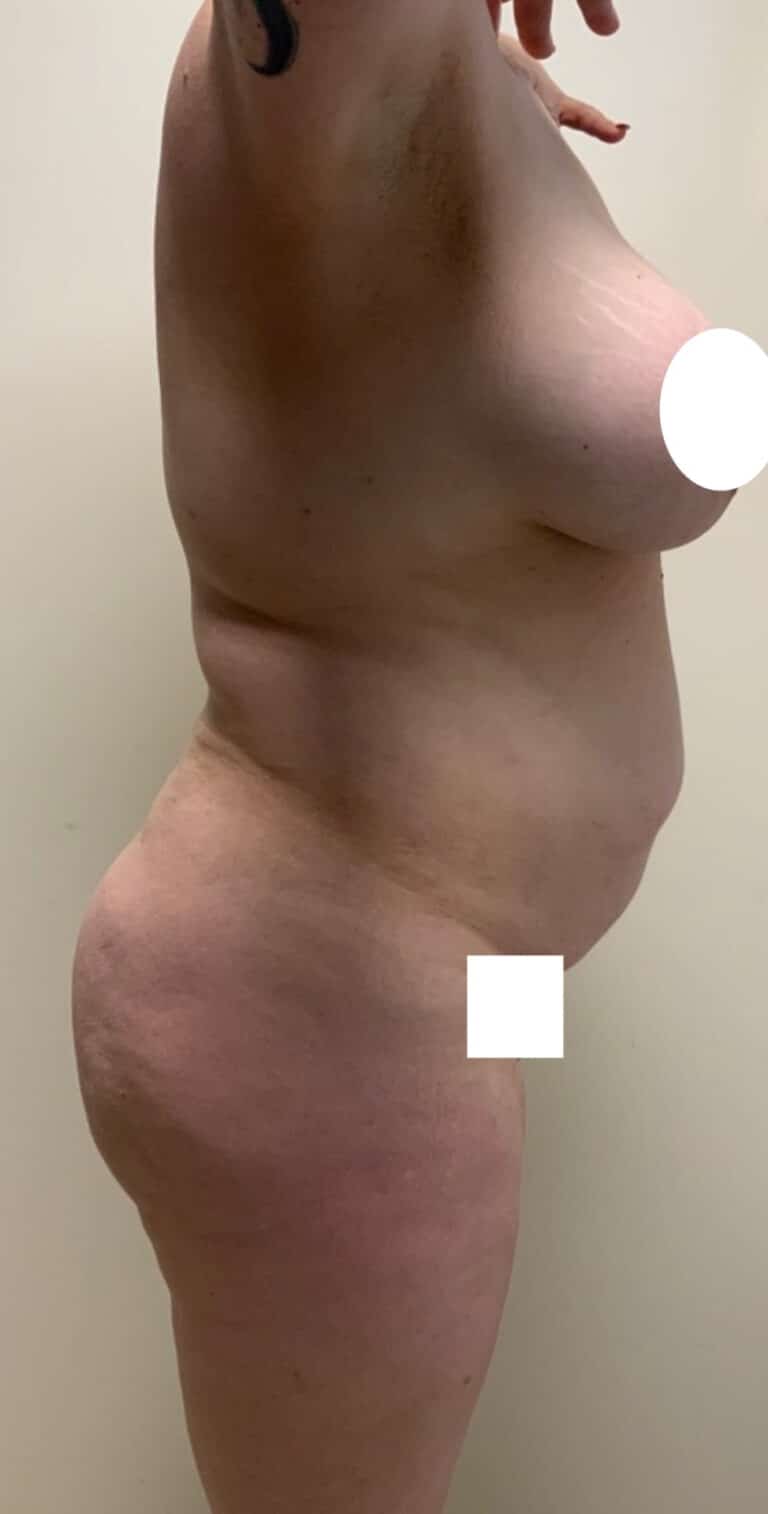 Before Image: Circumferential Mamacita Makeover - right-side