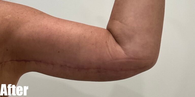 After Image: Long Scar Arm lift at 6 weeks post operative. - front