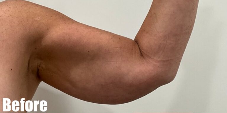 Before Image: Long Scar Arm lift at 6 weeks post operative. - front