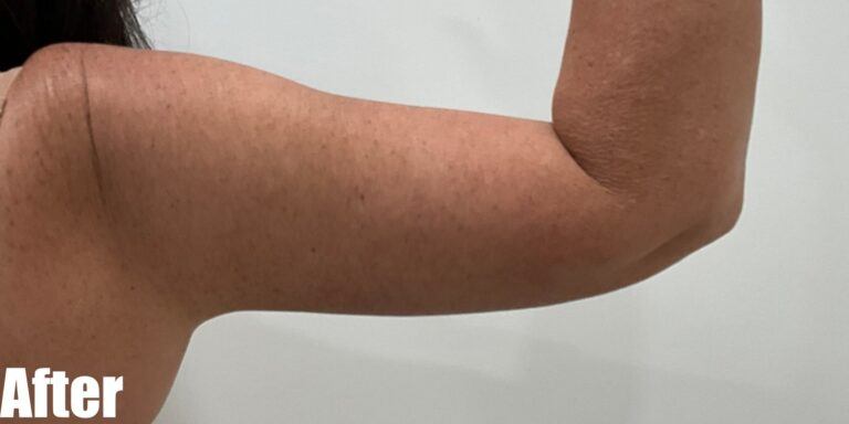 After Image: Long Scar Arm lift at 6 weeks post operative. - front