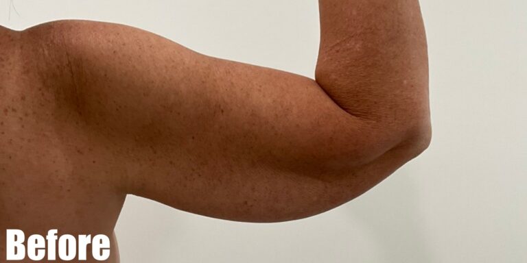 Before Image: Long Scar Arm lift at 6 weeks post operative. - front