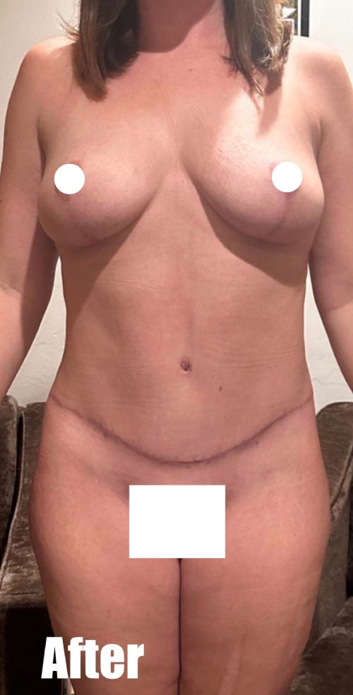 After Image: 35F Mommy makeover - front