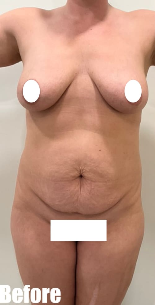 Before Image: 35F Mommy makeover - front