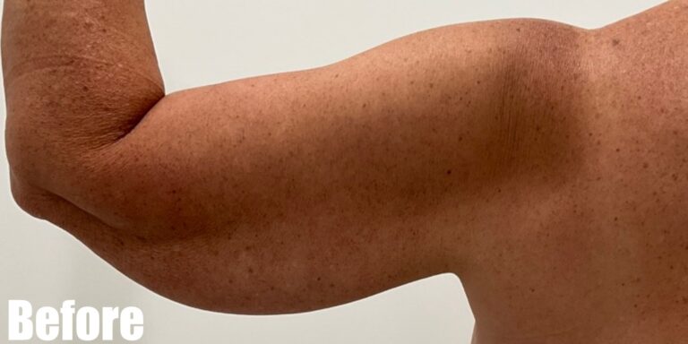 Before Image: Long Scar Arm lift at 6 weeks post operative. - front