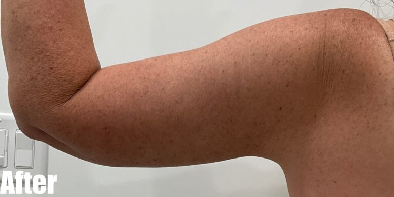 After Image: Long Scar Arm lift at 6 weeks post operative. - front