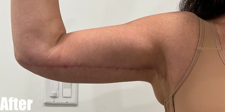 After Image: Long Scar Arm lift at 6 weeks post operative. - front