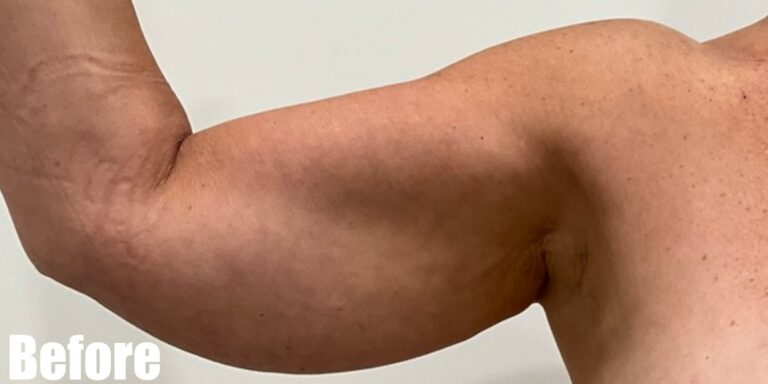 Before Image: Long Scar Arm lift at 6 weeks post operative. - front