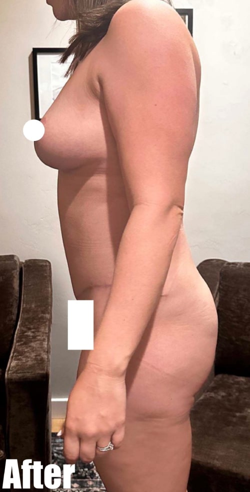 After Image: 35F Mommy makeover - left-side