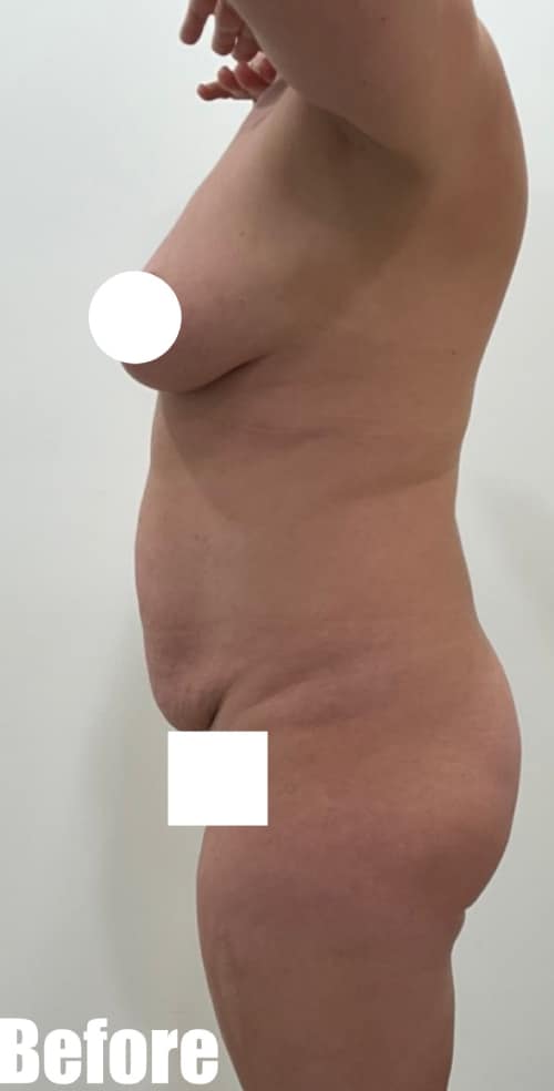 Before Image: 35F Mommy makeover - left-side
