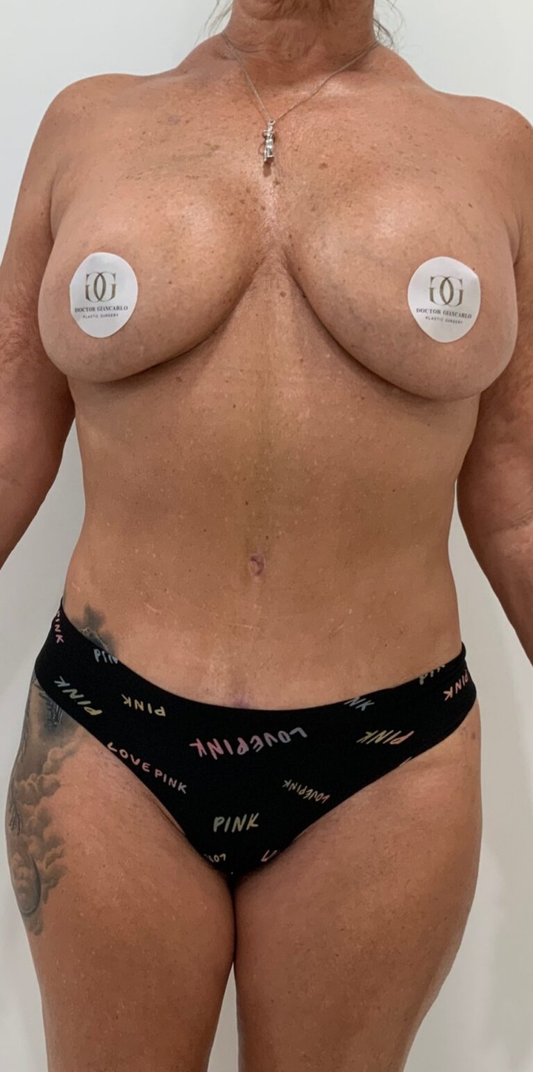 After Image: Circumferential Tummy Tuck - front
