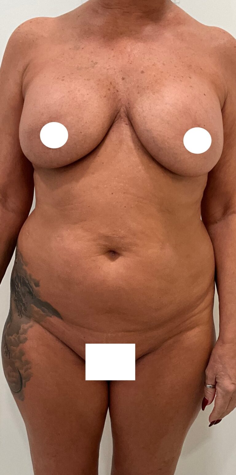 Before Image: Circumferential Tummy Tuck - front