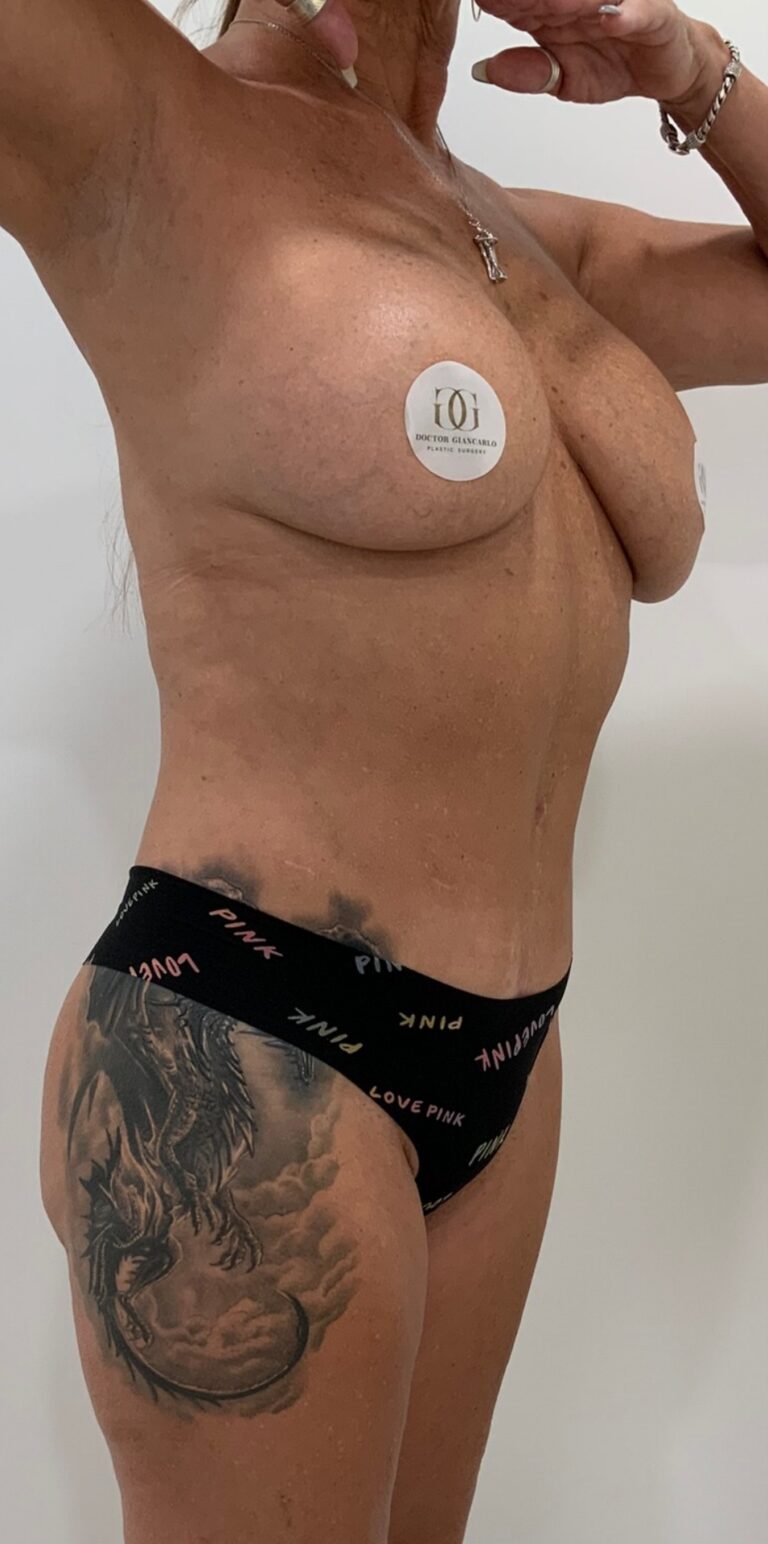 After Image: Circumferential Tummy Tuck - right-front-oblique