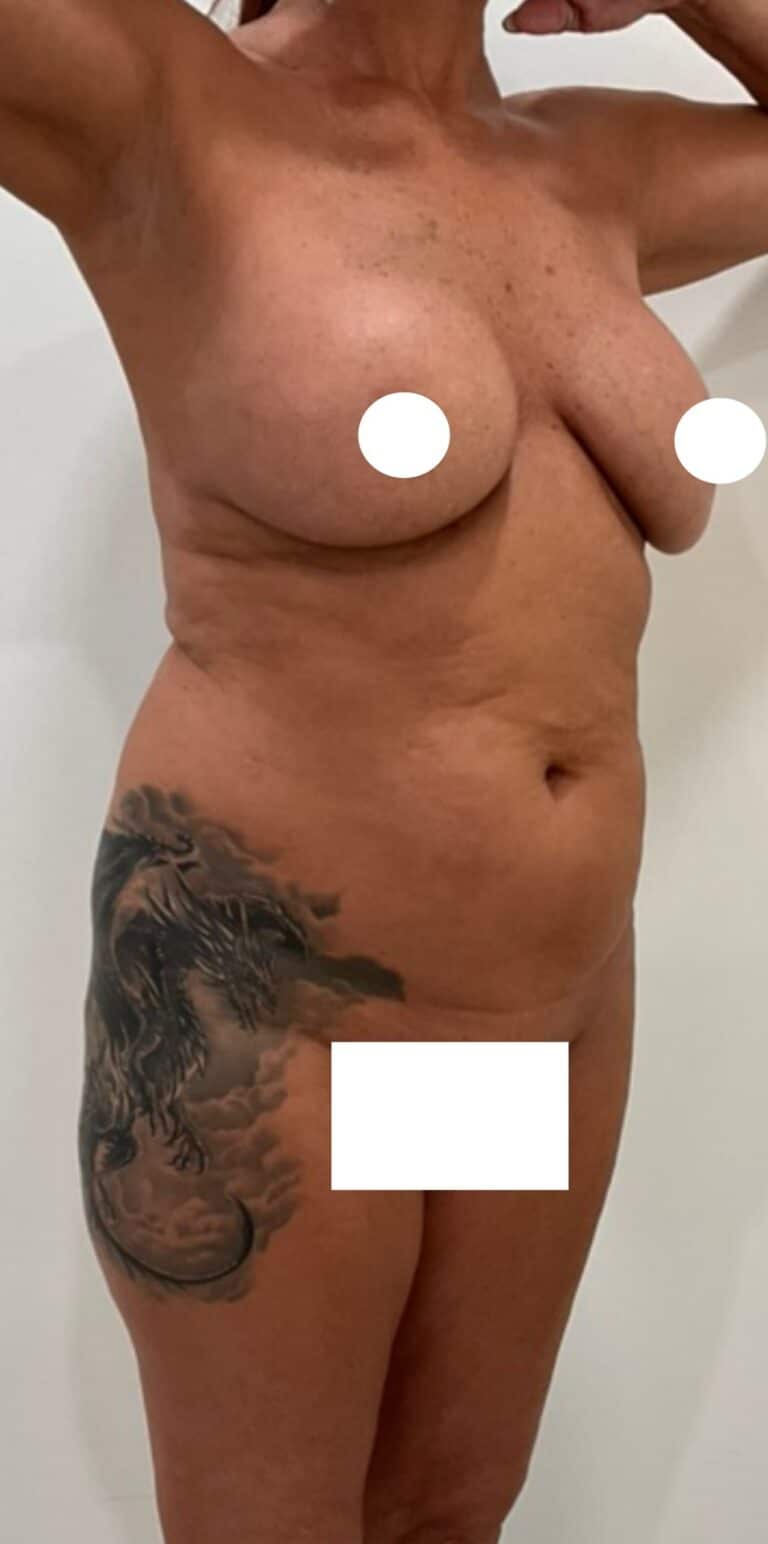 Before Image: Circumferential Tummy Tuck - right-front-oblique
