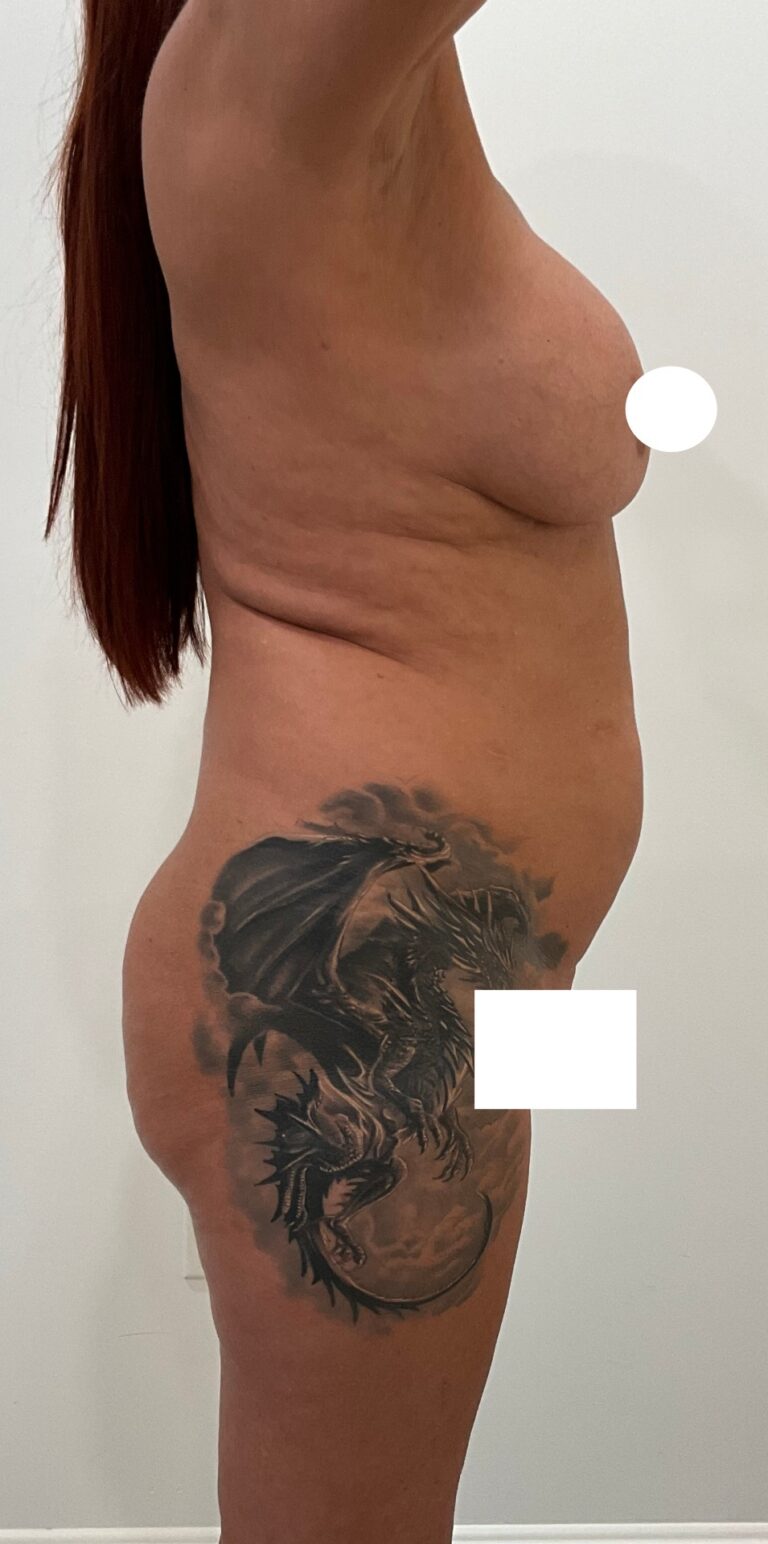Before Image: Circumferential Tummy Tuck - right-side