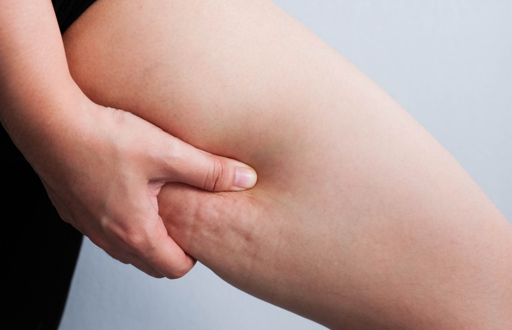Close-up of cellulite on a woman's thigh