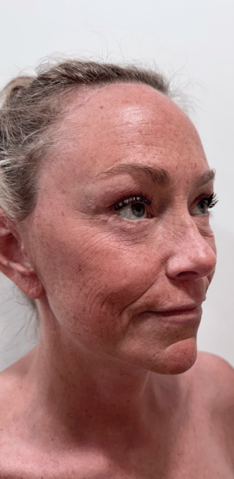 After Image: Face and Neck Lift with Fat Transfer Face - right-front-oblique