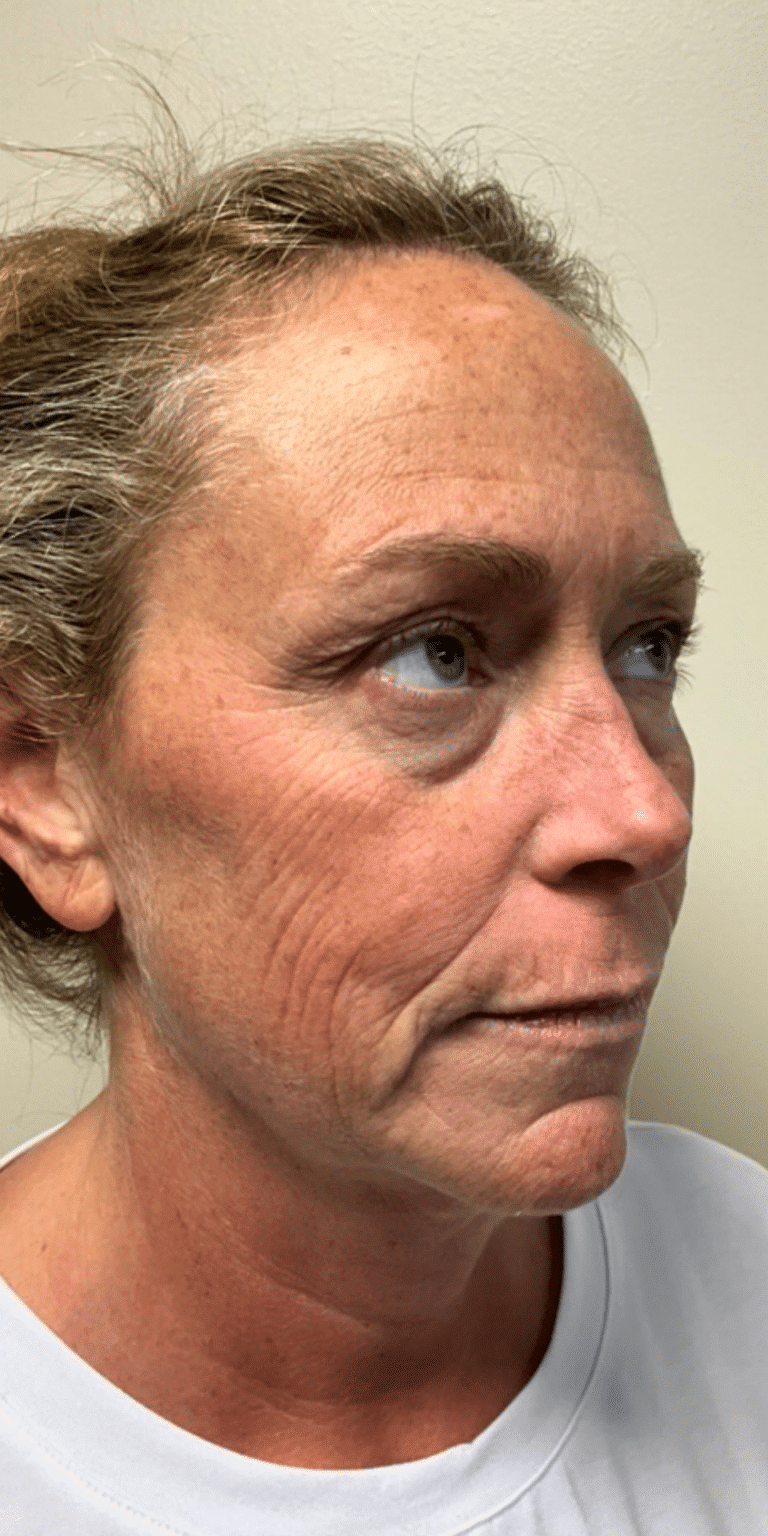 Before Image: Face and Neck Lift with Fat Transfer Face - right-front-oblique