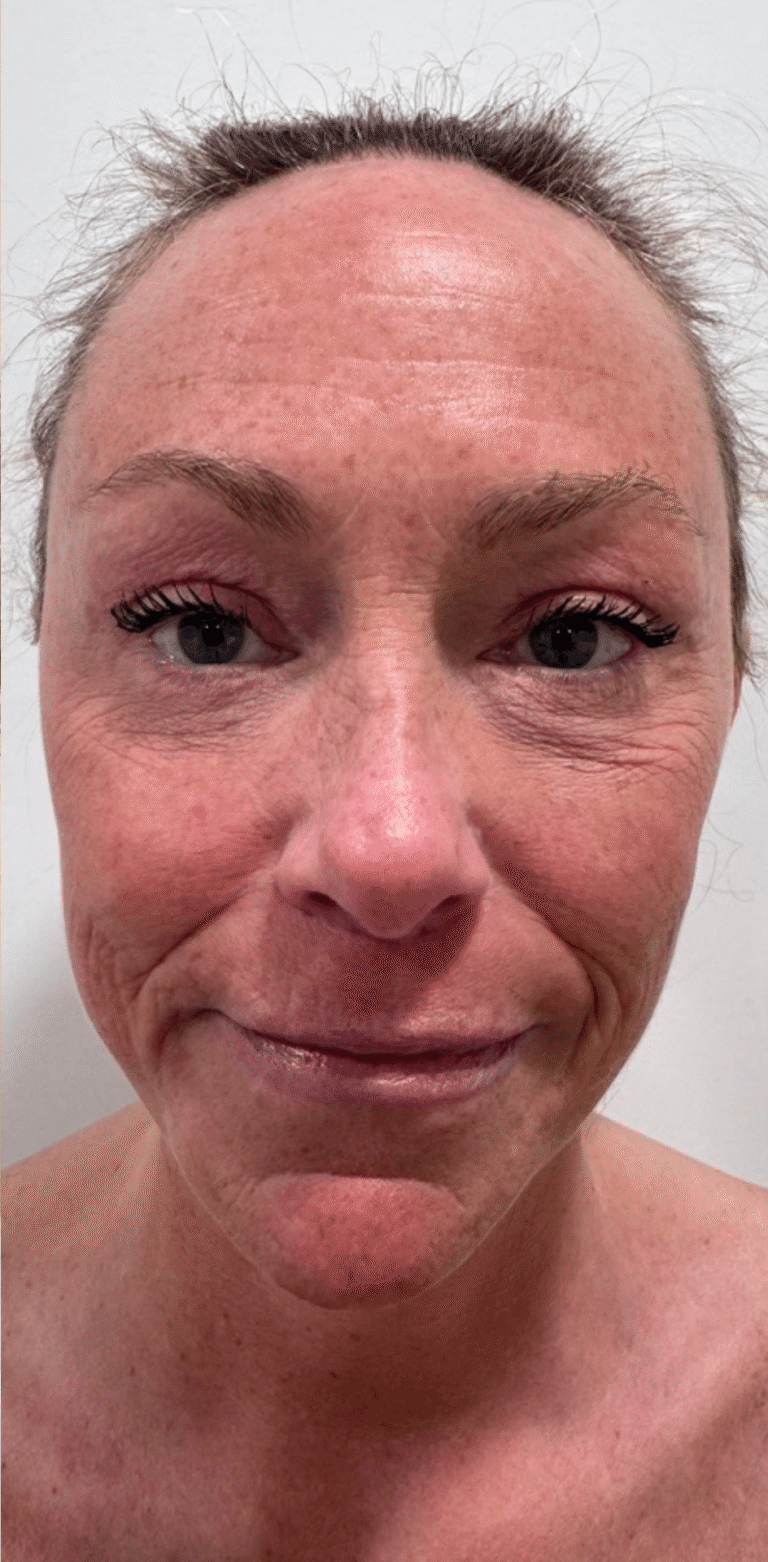 After Image: Face and Neck Lift with Fat Transfer Face - front