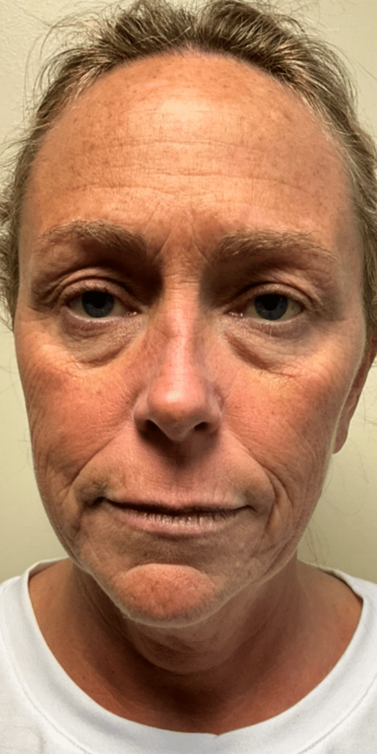 Before Image: Face and Neck Lift with Fat Transfer Face - front