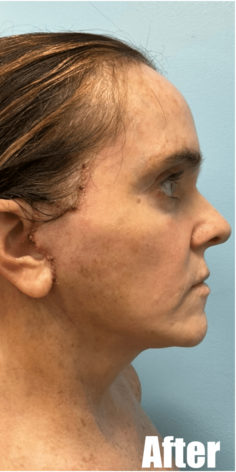 After Image: Face and Neck Lift with Fat Transfer Face - right-side