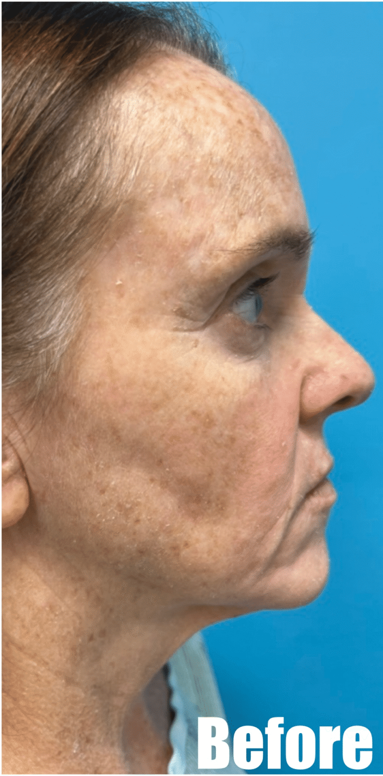 Before Image: Face and Neck Lift with Fat Transfer Face - right-side