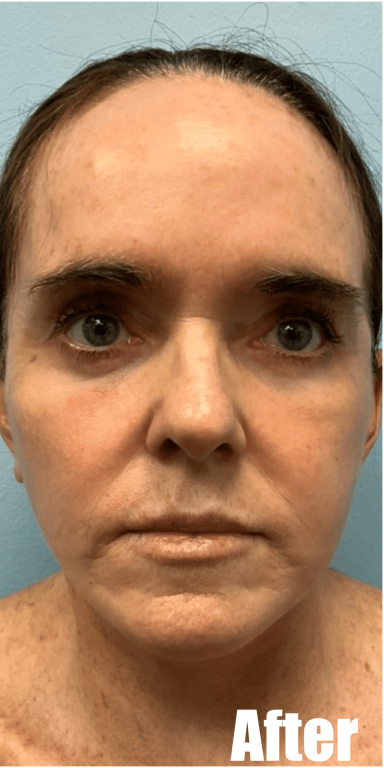 After Image: Face and Neck Lift with Fat Transfer Face - front