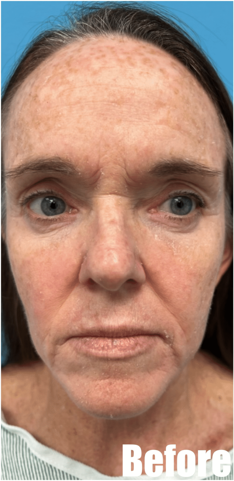 Before Image: Face and Neck Lift with Fat Transfer Face - front